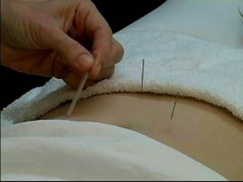 Akupunktur İle Ortak Rahatsızlıkları Tedavi : Akupunktur İle İdrar Sorunları Tedavi 