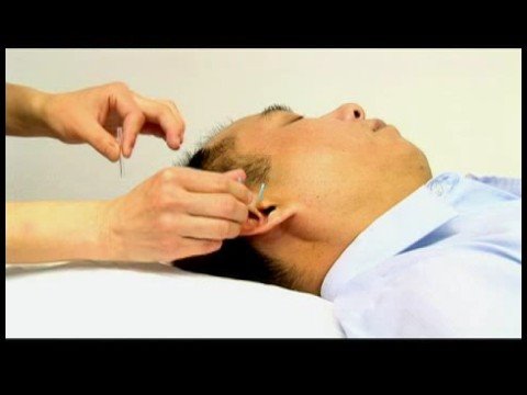 Akupunktur Detoksifikasyon İçin: Akupunktur Shen Men Noktasında