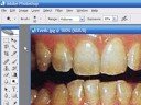 Nasıl Dijital Fotoğraf Düzenlemek İçin : Resimler Dişleri Daha Beyaz Hale Getirmek İçin Düzenleme 