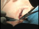 Blefaroplasti Ameliyatı Hakkında Tüm: Nasıl Dikiş Blefaroplasti Yordamlarda Yapılır Resim 2