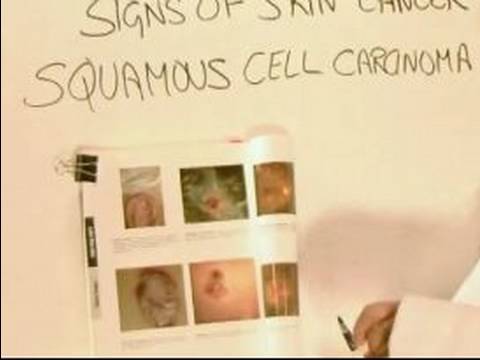 Cilt Kanseri Nasıl: Skuamöz Hücre Karsinomu Belirtileri Cilt Kanseri