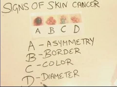 Nasıl Cilt Kanseri Tanımlamak İçin: Nasıl Deri Kanseri İşaretleri İçin Vücudunuzun İncelemek İçin