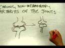 Osteoartrit Semptomlarını Tedavi Etmek İçin Nasıl : Osteoartrit Nedir? Resim 4