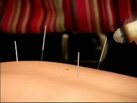Akupunktur İle Ortak Rahatsızlıkları Tedavi : Akupunktur İle Bağımlılık Tedavisi Hakkında 