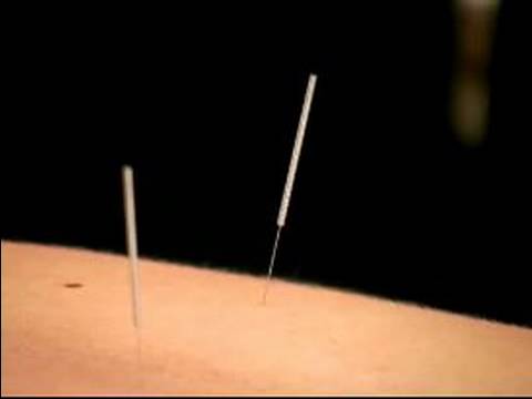 Akupunktur İle Ortak Rahatsızlıkları Tedavi : Akupunktur İle Böbrek Tedavisi 