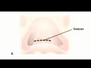 Hakkında Rinoplasti (Burun Ameliyatı): Bir Sapma Septum Nedir?