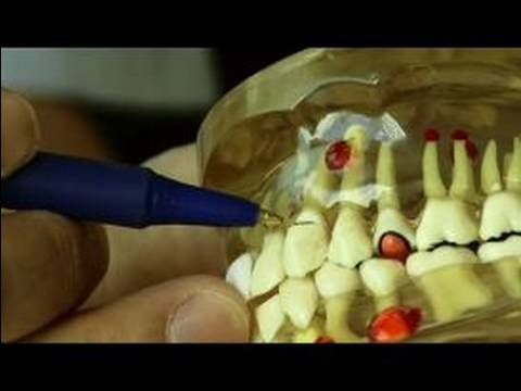 Kanal Tedavisine İhtiyacım Var Mı? Diş Çürüğü Belirtileri Çürüme Kök  Resim 1
