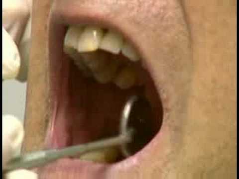 Diş Bakımı: Koronal Diş Parlatma : Koronal Diş Parlatma: Çift Kontrol Sonuçları