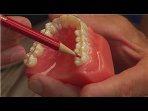 Diş Ve Diş Eti Apse : Diş Hekimleri Ne Kadar Da Dişlerde Bir Dişin Drenaj 