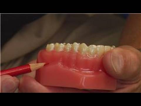 Diş Ve Diş Eti Apse : Diş Tabakasının Kaçınmak İçin Cerrahi Apse Resim 1