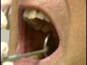 Diş Bakımı: Koronal Diş Parlatma : Koronal Diş Parlatma: Çift Kontrol Sonuçları Resim 3