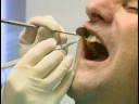 Diş Bakımı: Koronal Diş Parlatma : Koronal Diş Parlatma: Tartar Çıkarma  Resim 4