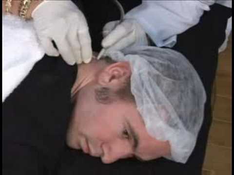 Elektroliz Epilasyon: Elektroliz Erkek Boyun Saç Kaldırma Tedavi Resim 1