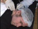 Elektroliz Epilasyon: Elektroliz Erkek Boyun Saç Kaldırma Tedavi Resim 3