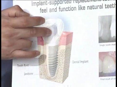Diş İmplant Cerrahisi : İmplant Parçaları