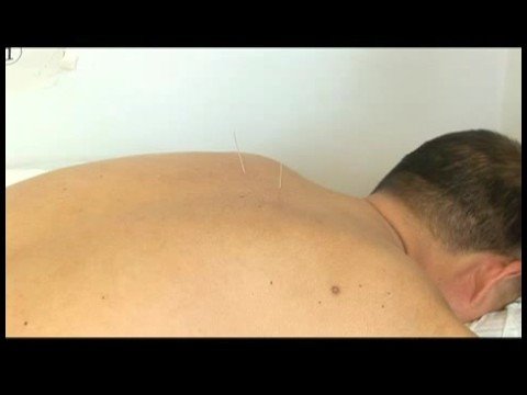 Akupunktur Sağlık Önerileri : İğne Manipülasyon Akupunktur  Resim 1