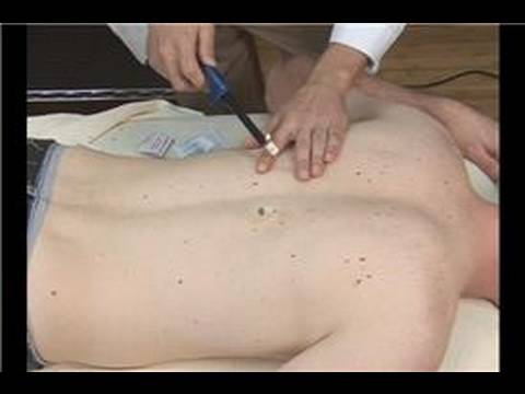 Yakı Faydaları : Akupunktur İle Yakı  Resim 1