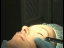 Blefaroplasti Ameliyatı Hakkında: Ne Anestezi Blefaroplasti İçinde Kullanılır Resim 4