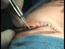 Tüm Blefaroplasti Ameliyatı Hakkında: Blefaroplasti İşlemler Nasıl Cilt Kaldırıldı Resim 4