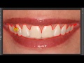 Photoshop: Nasıl Aydınlatmak Ve Dişleri Beyazlatmak İçin! Resim 3