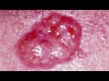 Bazal Hücre Karsinomu İşaretler Ve Belirtiler | Cilt Kanseri Resim 3